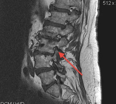 Lumbar MRI Tight Intervertebral Foramina L3